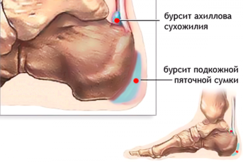 Бурсит пяточной сумки и аххилова сухожилия