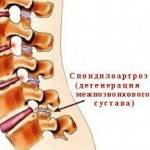 Спондилоартроз