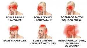 Головные боли при остеохондрозе