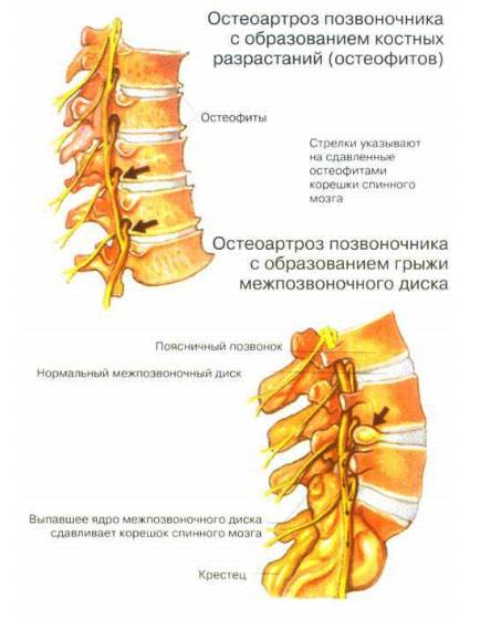 Причины остеохондроза позвоночника Причины остеохондроза позвоночника