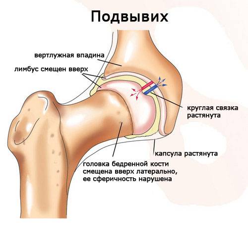 Как выглядит вывих на схеме Как выглядит вывих на схеме