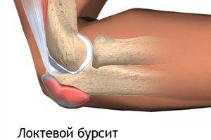 Бурсит локтевого сустава