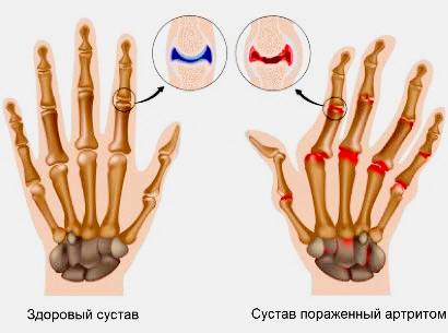 Лечение артрита пальцев рук Что такое артрит пальцев рук?