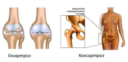 Гонартроз и коксартроз