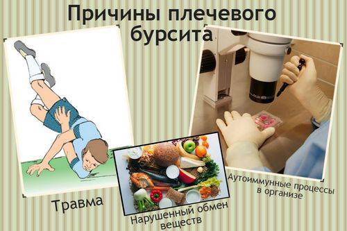 причины бурсита плеча