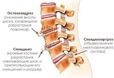Дегенеративно-дистрофические заболевания позвоночника остеохондроз