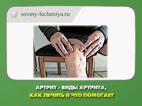 как лечить Артрит