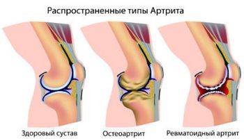 Популярные вопросы про артрит и ответы на них Что такое артрит, можно ли его вылечить, причины появления - на эти и на другие вопросы вы получите ответы в этой статье