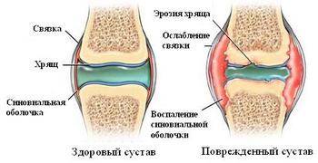 Популярные вопросы про артрит и ответы на них Что такое артрит, можно ли его вылечить, причины появления - на эти и на другие вопросы вы получите ответы в этой статье