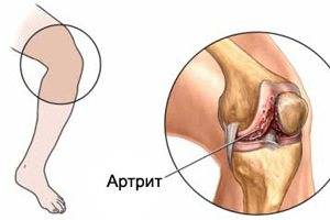 Гнойный артрит