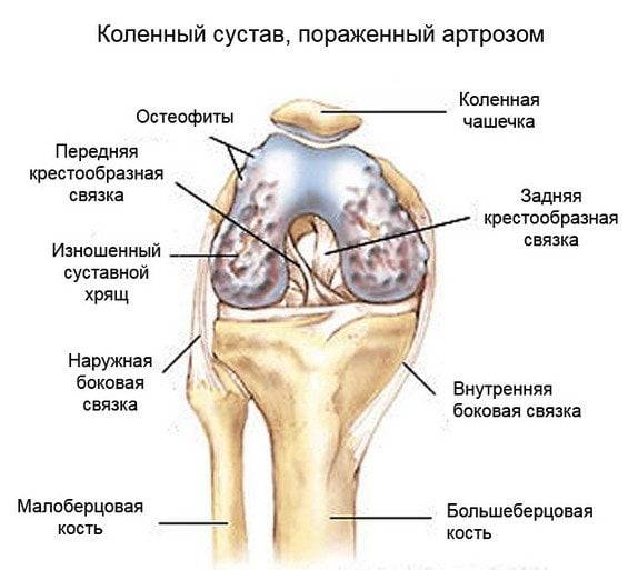 Артроз колена