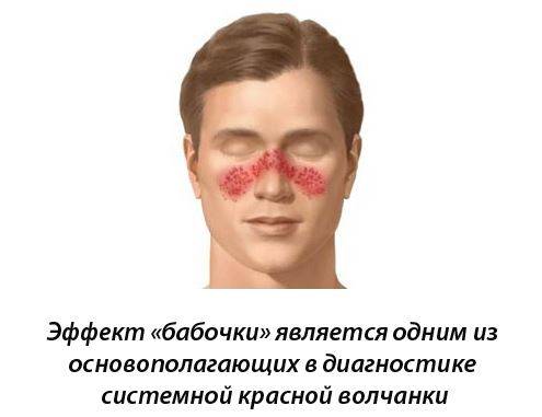 Артрит суставов