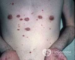 Реактивный артрит обычно сопровождается сыпью