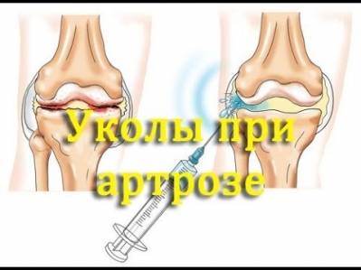 уколы при артрозе