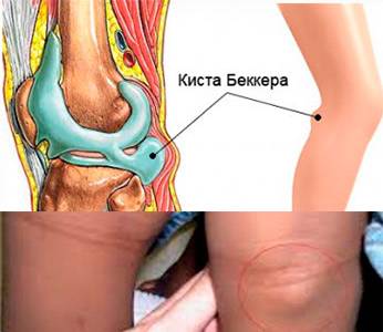 Киста Бейкера колена