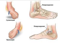 повреждение голеностопа