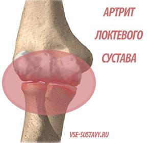 симптомы артрита локтя сустава