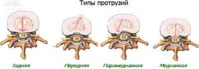 типы протрузий