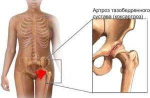 Коксартроз тазобедренного сустава