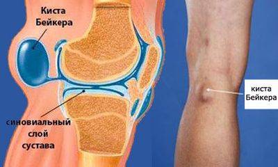 Удаление кисты бейкера коленного сустава