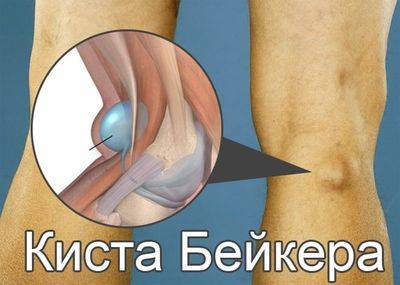 Удаление кисты бейкера коленного сустава