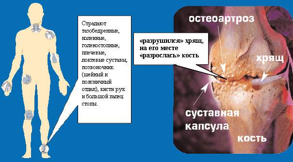 Спондилоартроз грудного отдела позвоночника