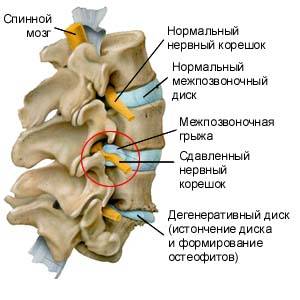 сдавливание нервных корешков