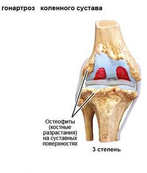 костные разрастания на суставных поверхностях