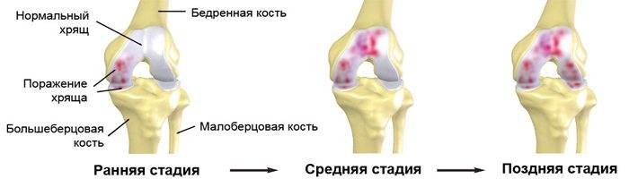 Степени артроза коленного сустава