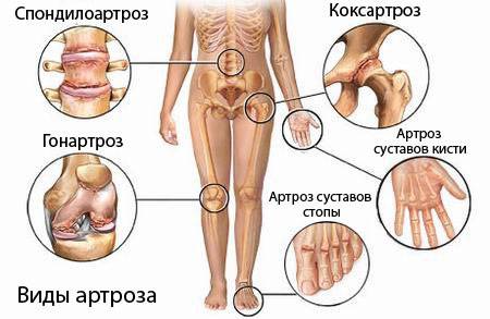Виды артрозов