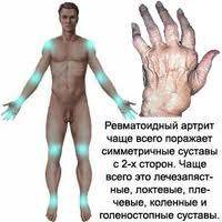 Схема лечения артрита