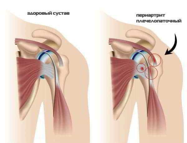 Синовит плечевого сустава