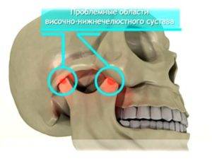 Рисунок показывает проблемные области образования ВНЧС Советы о том где появляется артроз височно-нижнечелюстного сустава