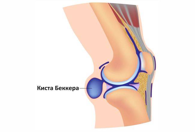 Киста Беккера под коленом - это патология, причиняющая большой дискомфорт Киста Беккера под коленом - это патология, причиняющая большой дискомфорт