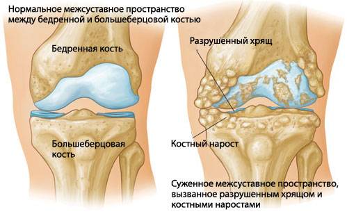 Артрит коленного сустава