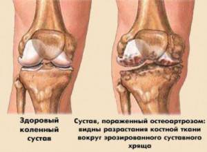 Степени артроза