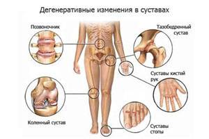Виды артроза