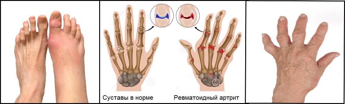 Средство от артрита