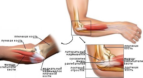 фото эпикондилита