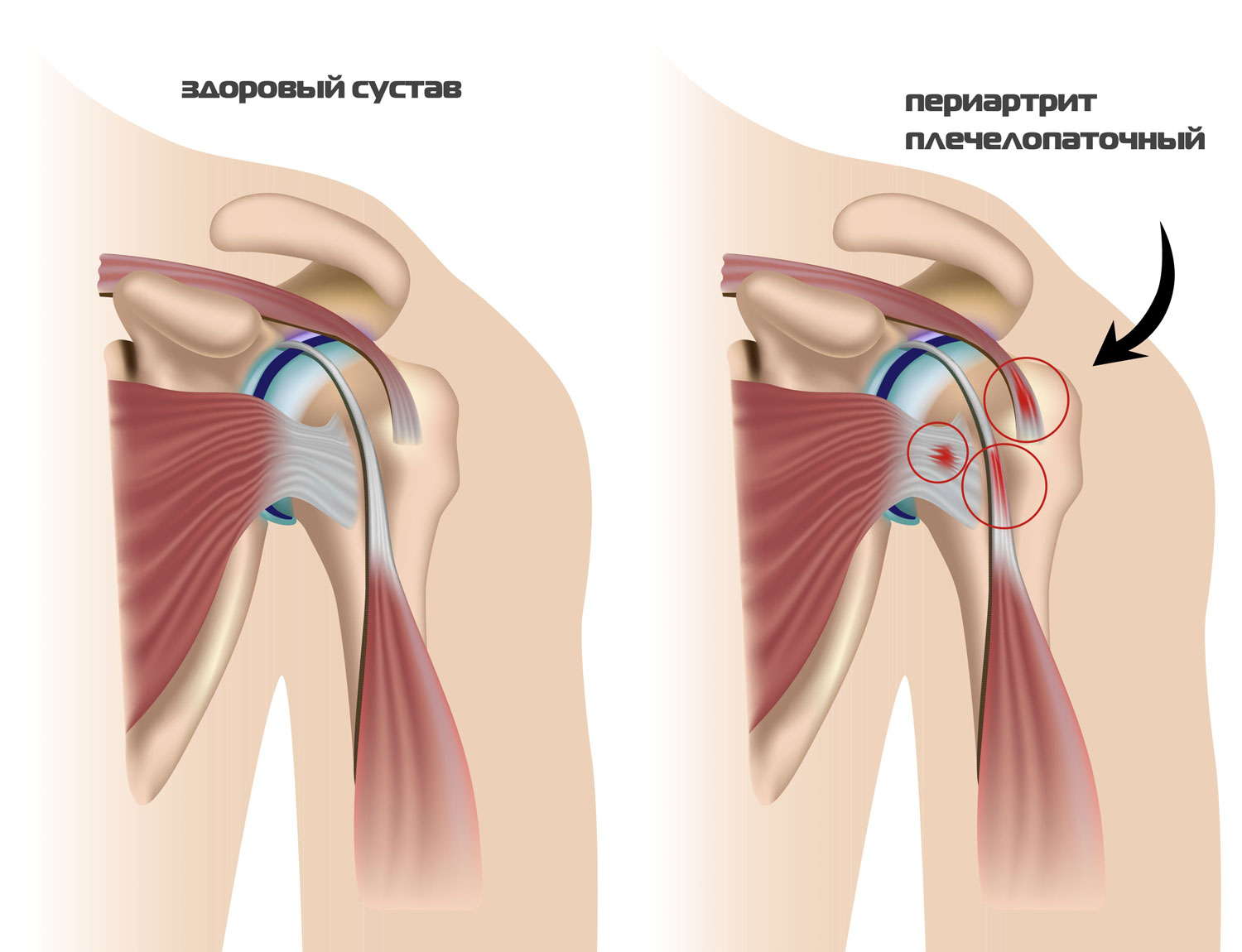 Плечевой полиартрит симптомы и лечение