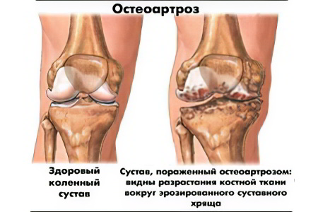 Причины остеоартроза
