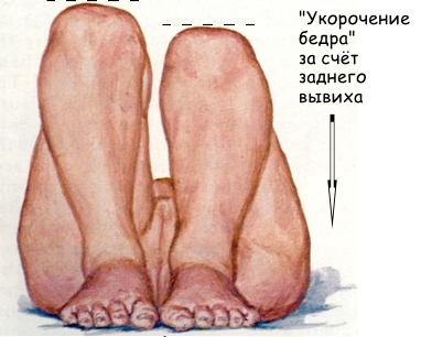 Дисплазия суставов у детей