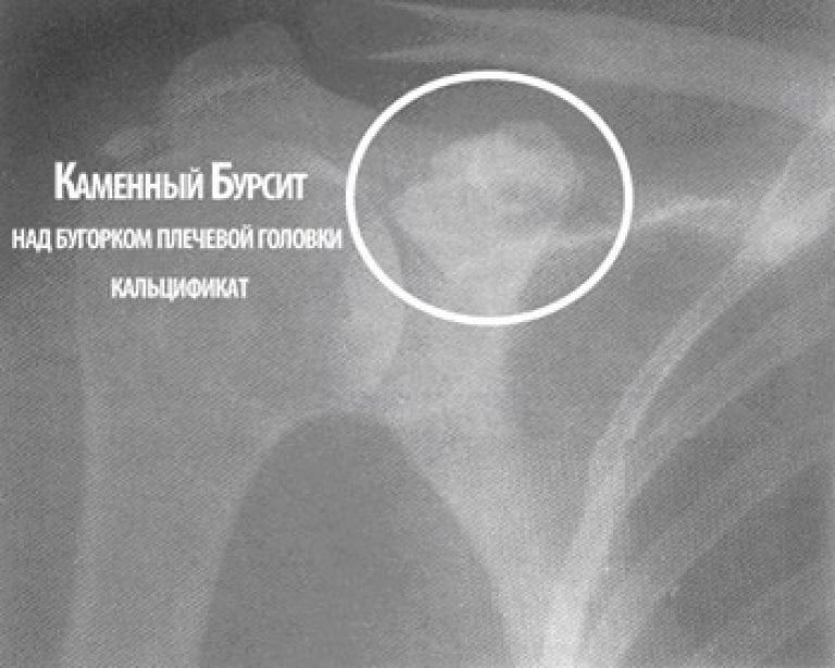 Бурсит плечевого сустава симптомы