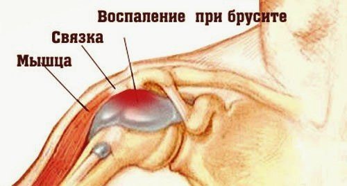 Воспаление плечевого сустава при бурсите Бурсит плеча