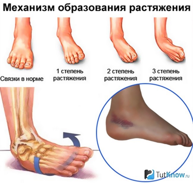 травма голеностопного сустава